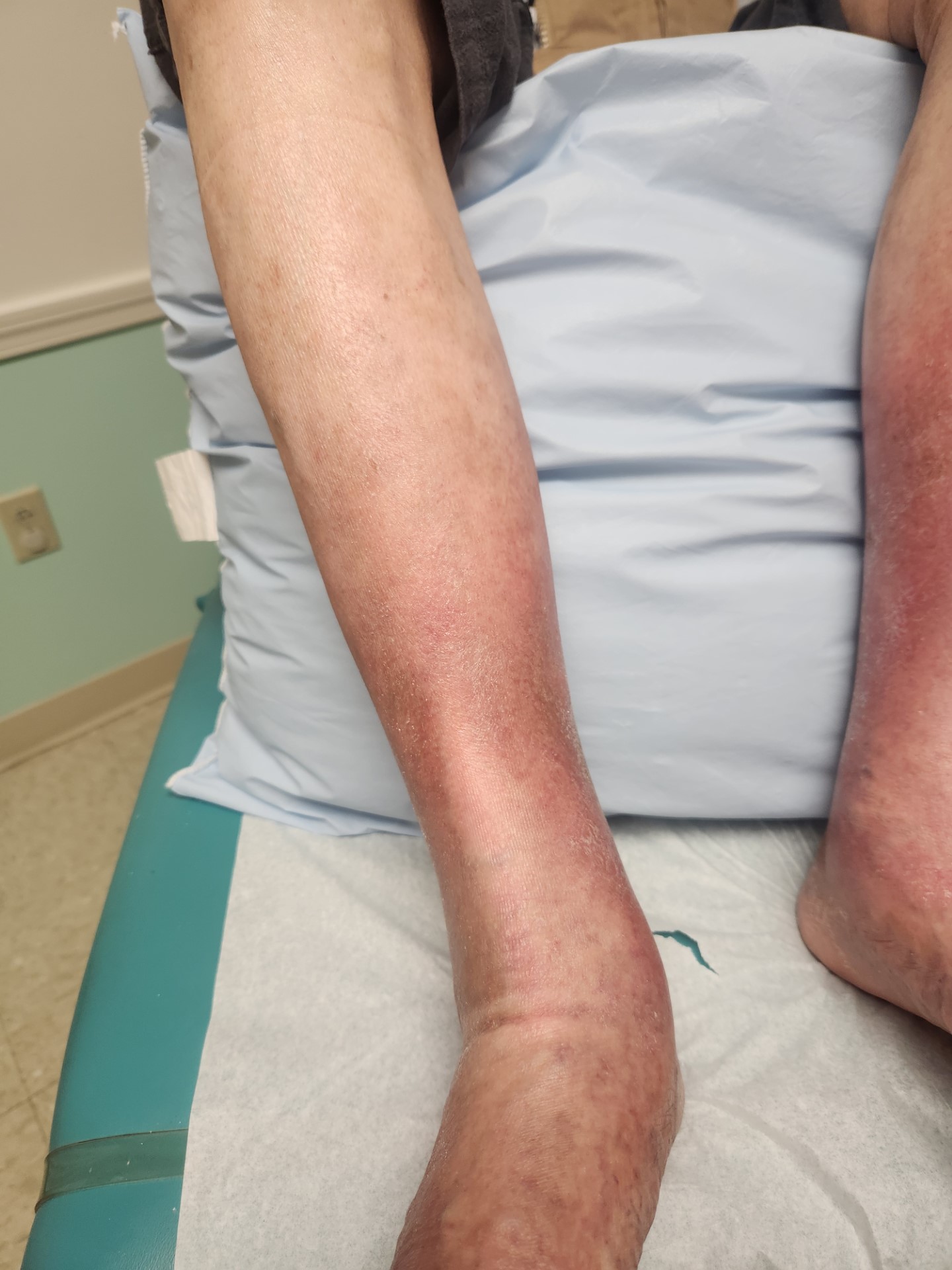 Venous ulcer & stasis dermatitis - after treatment