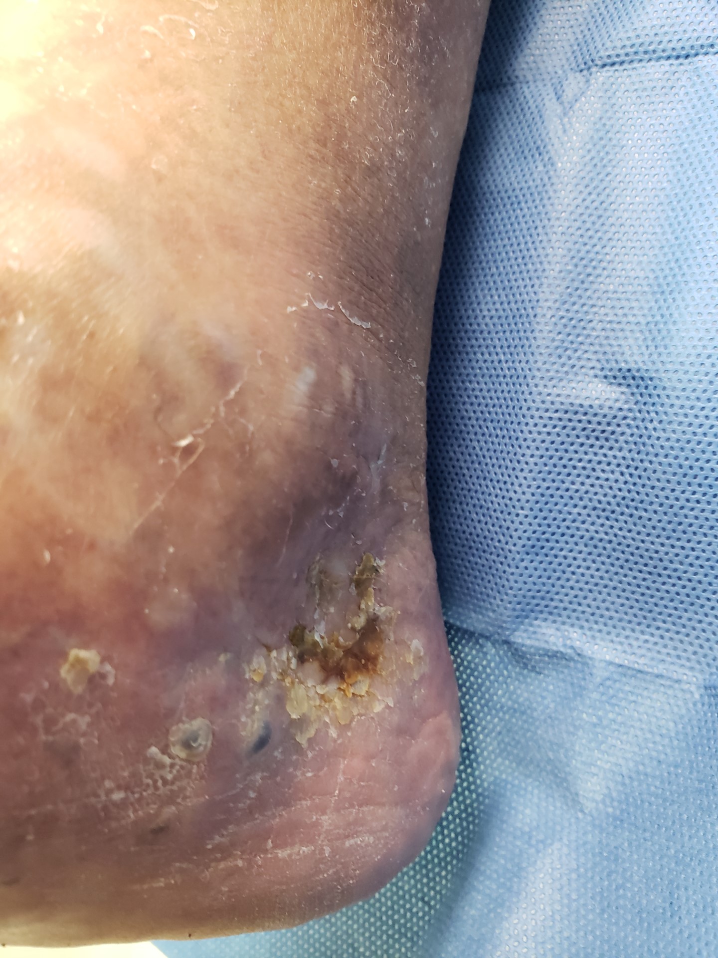 Venous ulcer & stasis dermatitis - before treatment