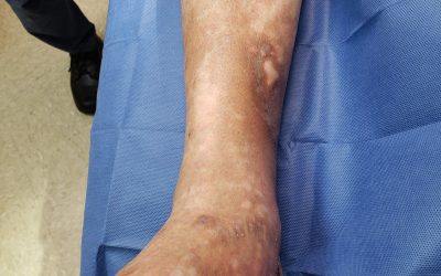 Chronic Leg Ulcers