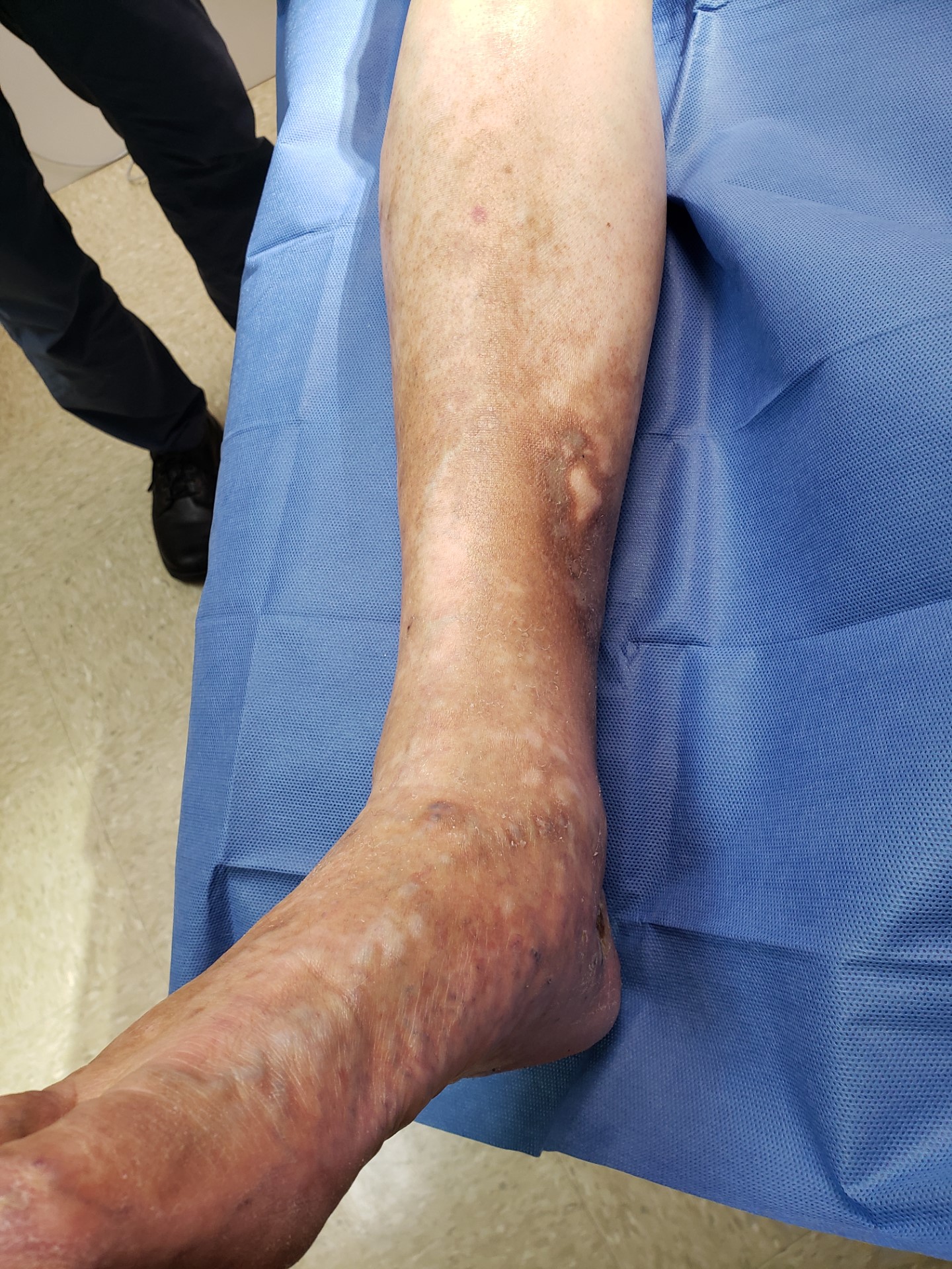 Venous Ulcers & Stasis Dermatitis Before Treatment