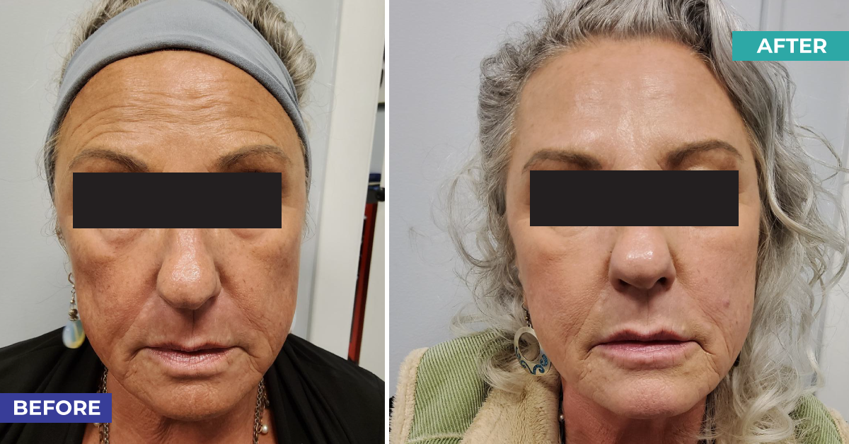 Silhouette Thread Lift, Juvéderm, and Botox: A Winning Combination