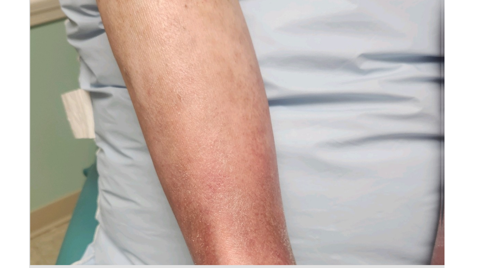 Chronic venous insufficiency and chronic venous dermatitis after treatment