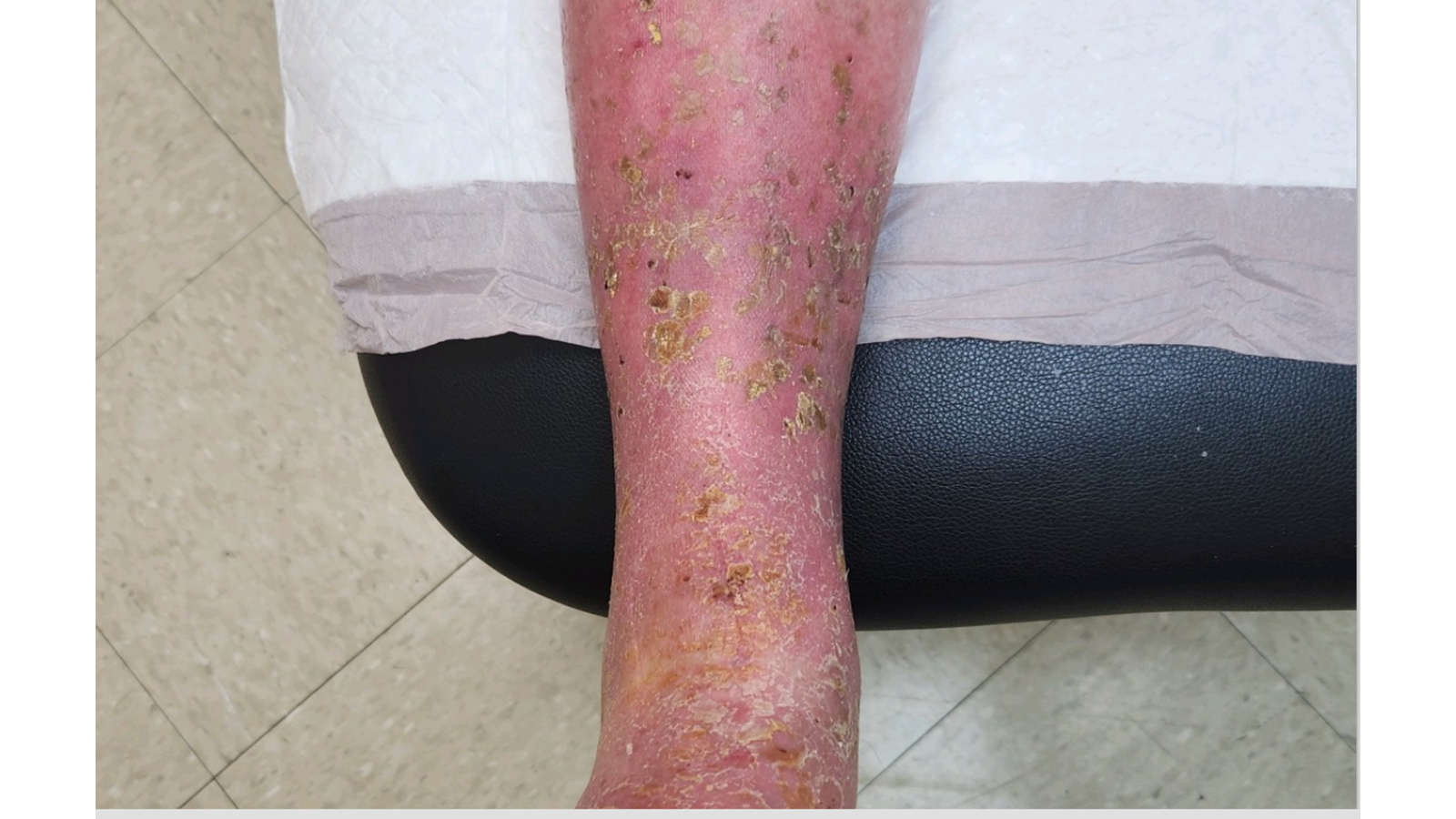 Chronic venous insufficiency and chronic venous dermatitis before treatment