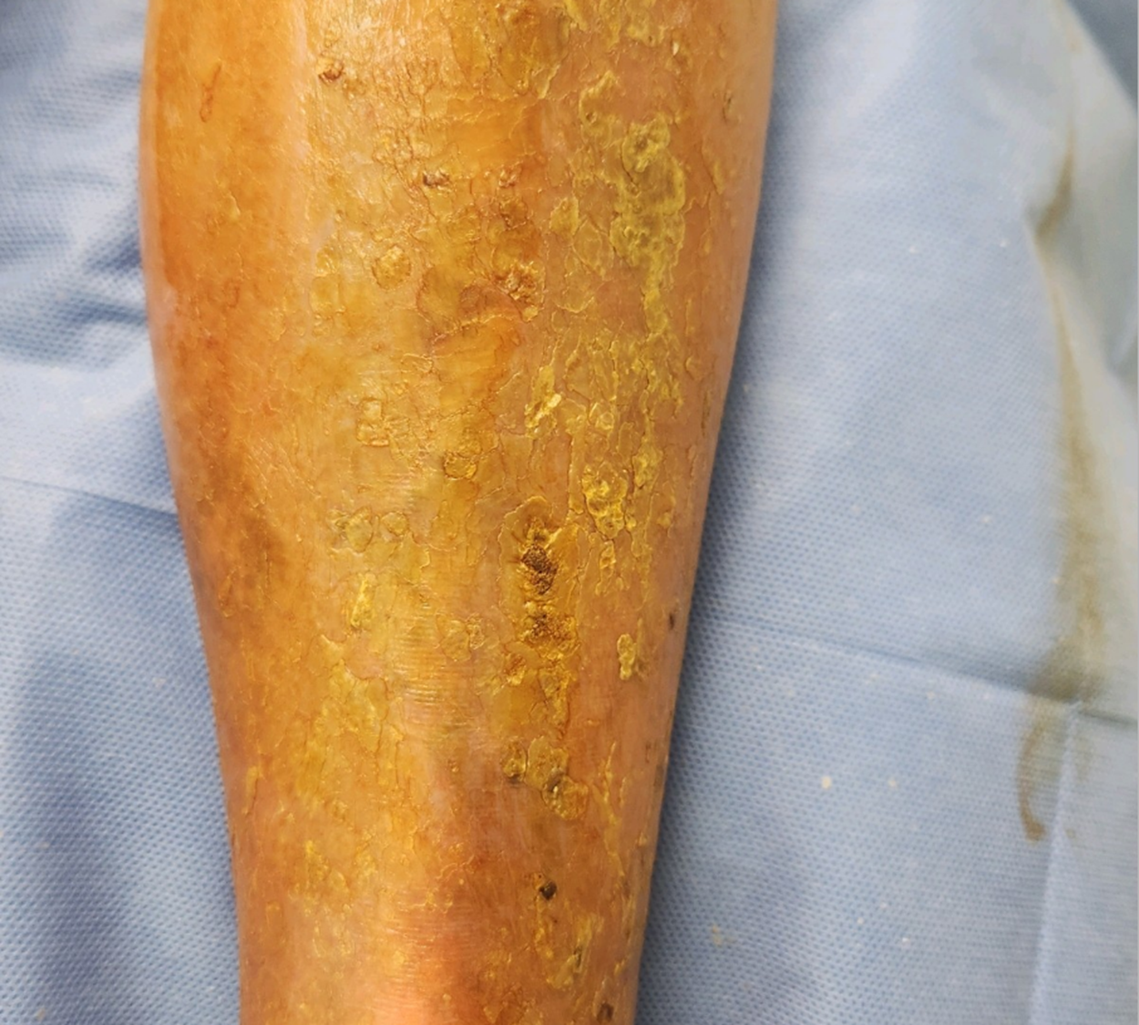 Venous Ulcer - after Venefit, EVLT, and Foam Sclerotherapy Treatment