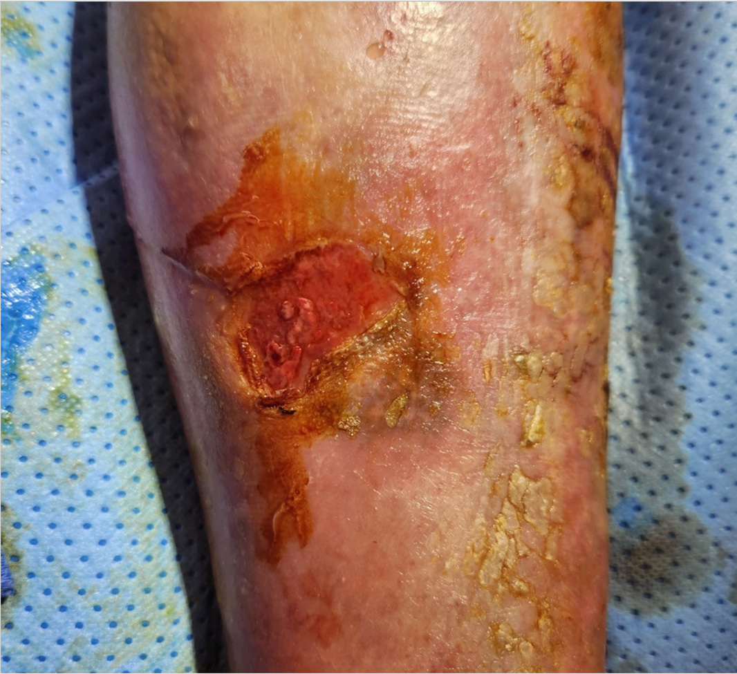 Venous Ulcer - before treatment