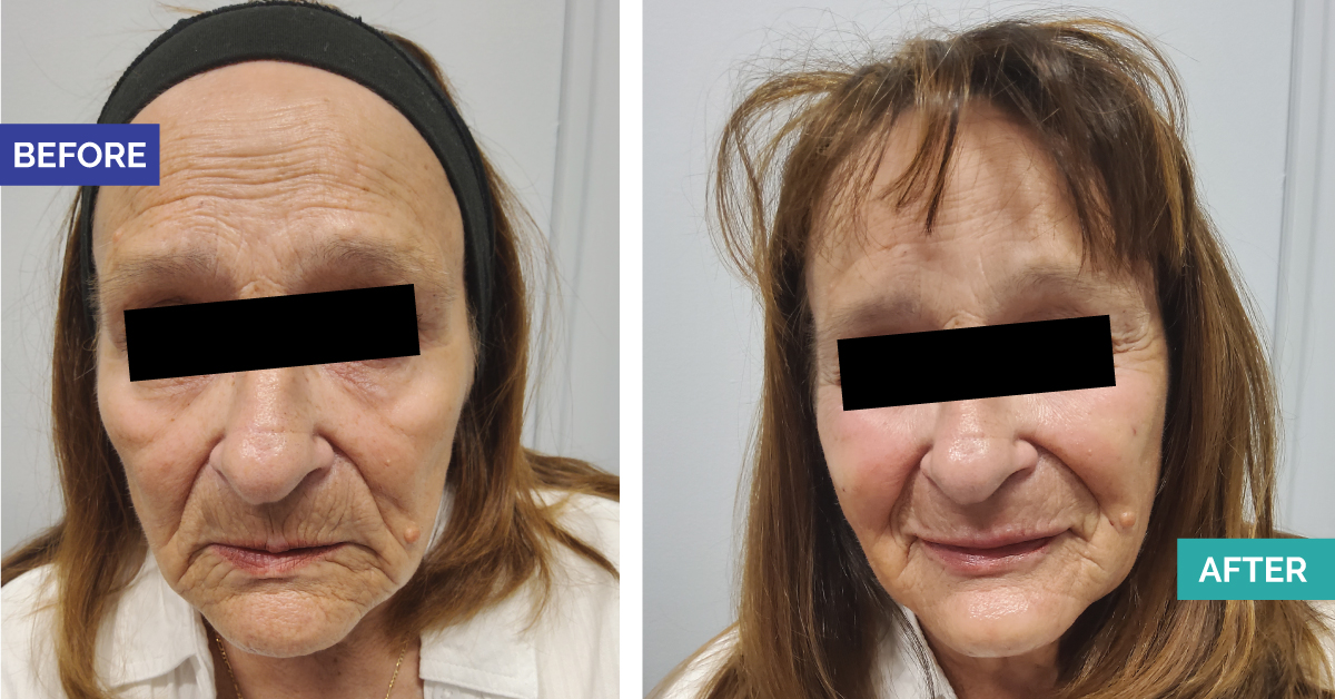 Instalift Thread Facelift and Juvaderm Filler