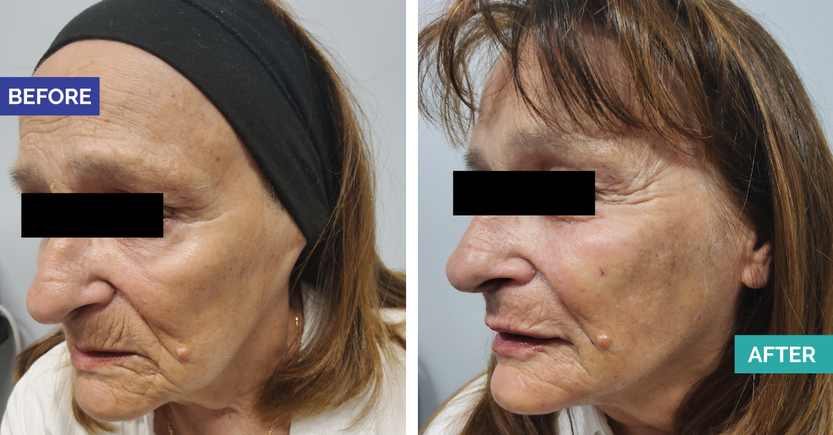 Instalift Thread Facelift and Juvaderm Filler